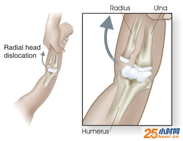 桡骨小头半脱位，一般可以通过手法复位，看似简单，实际需要医生经过专门的训练才能准确完成，不建议家长自己尝试，否则可能出现复位不完全，神经损伤或者骨折。
